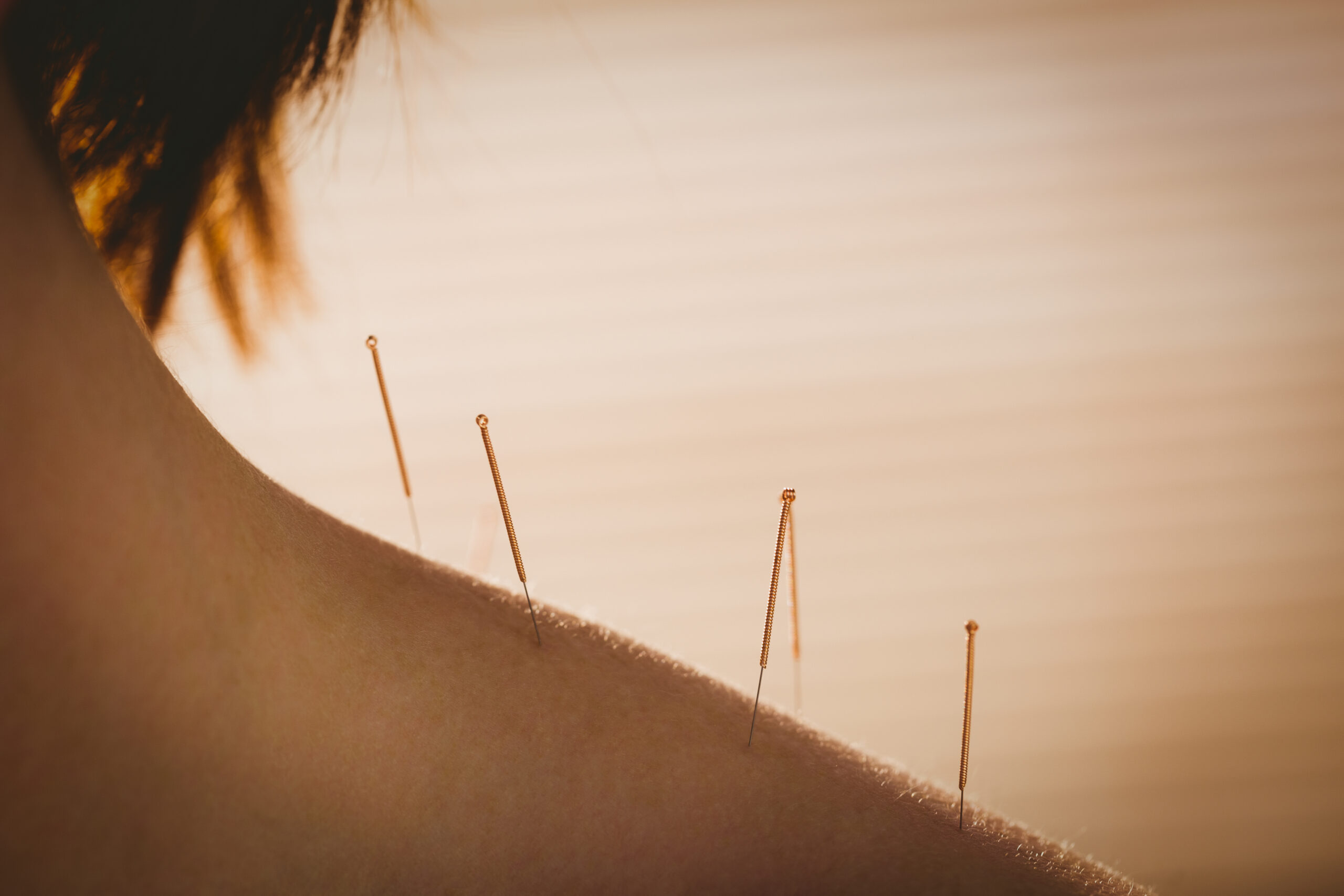 Acupuncture With Help From The Other Side